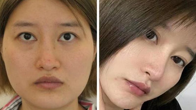 医美耗材，品质背后的品牌力量