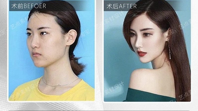 埋线提升：揭秘其优缺点，助你理性选择