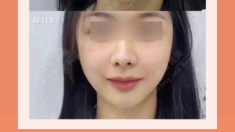 小标题：肉毒素除皱原理