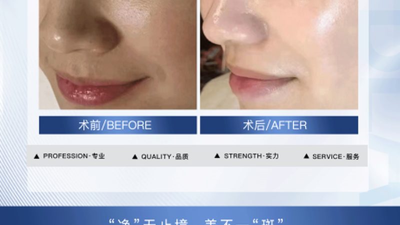 激光美容加盟，揭秘费用背后的秘密