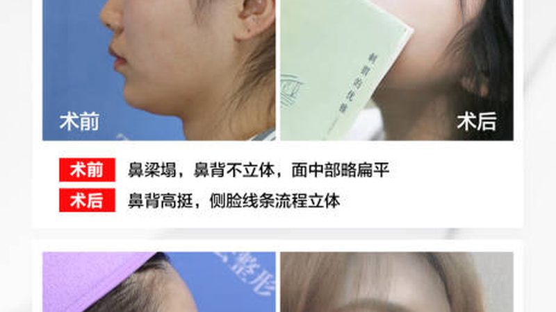 家用微针与水光针：揭秘两者差异与适用场景