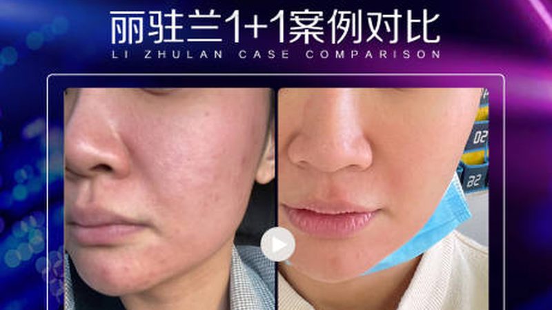 激光脱毛：一疗程与单次价格背后的考量