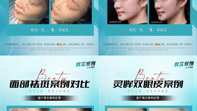 埋线提升PDO线价格乱象背后：厂家直销的真实逻辑