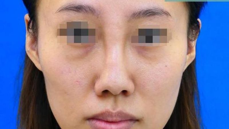 小标题：术后护理的重要性